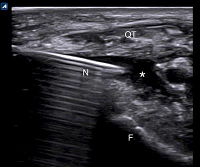 Efficacy of a single ultrasound-guided injection of high molecular weight hyaluronic acid combined with collagen tripeptide in patients with knee osteoarthritis and chondrocalcinosis